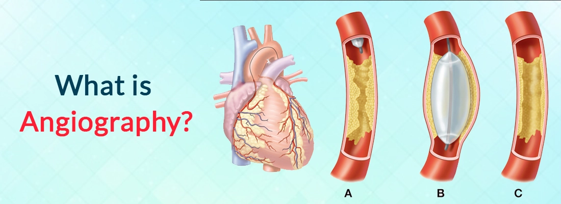 What Is Angiography
